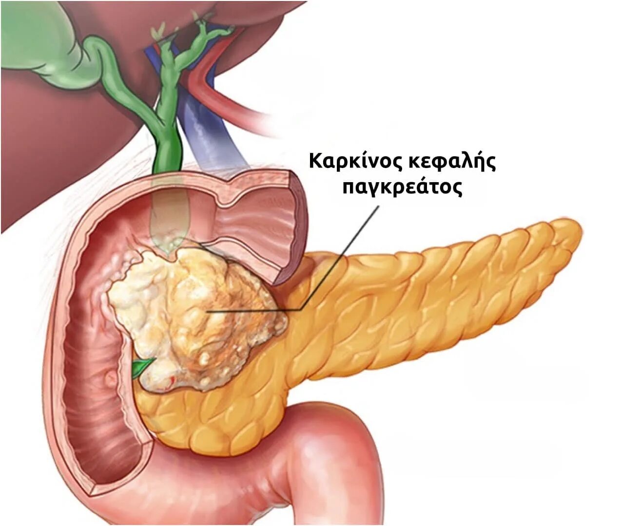 Опухоль головки поджелудочной железы. Tuber omentale поджелудочной железы. Новообразование головки поджелудочной железы. Карцинома головки поджелудочной железы.