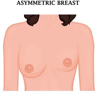 breast asymmetry 