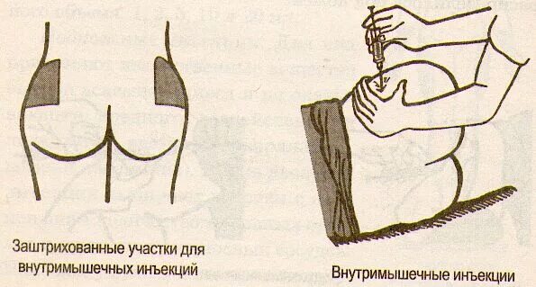 Уколы в ягодицу маленьким. Схема постановки внутримышечной инъекции. схема инъекции в ягодицу внутримышечно. техника введения внутримышечной инъекции в ягодицу. алгоритм внутримышечной инъекции схема.