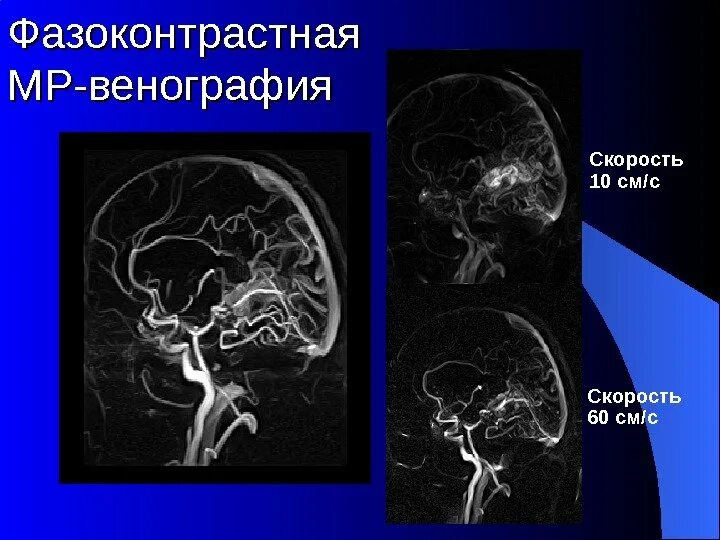 Венография головного мозга. Кт-венография тромбоз сосудов головы. Ангиография и венография. МР венография.