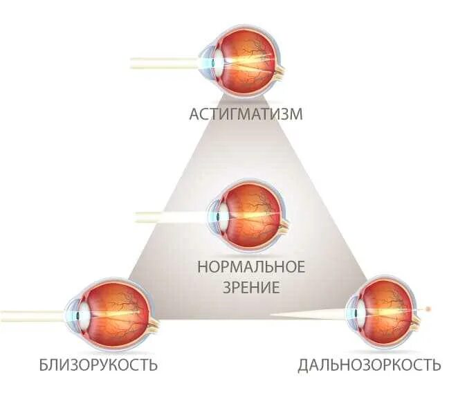 Сложный гиперметропический астигматизм глаз. Миопический астигматизм. Сложный гиперметропический астигматизм. Сложный миопический астигматизм ou. Сложный гиперметропический астигматизм обоих глаз.