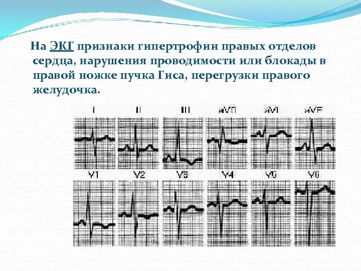 Блокада правого желудочка. ЭКГ гипертрофия правого желудочка и блокада правой ножки пучка Гиса. Гипертрофия желудочков на ЭКГ. Гипертрофия правого желудочка с перегрузкой на ЭКГ. Блокада правого желудочка на ЭКГ.