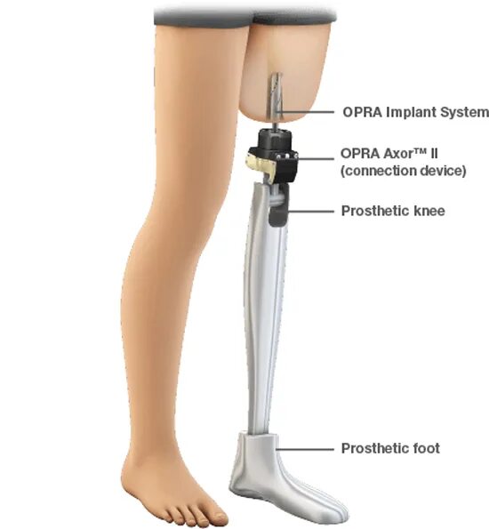 Ноги выше колена. Протезы для ног коленный сустав. Протез ноги выше колена с пружиной. Конструкции протезов для ног выше колена.