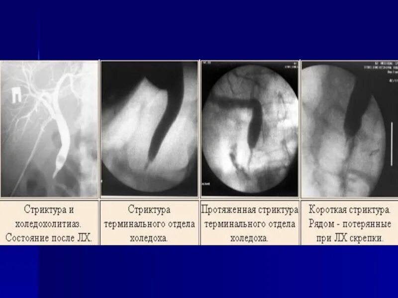 Осложнения стеноза