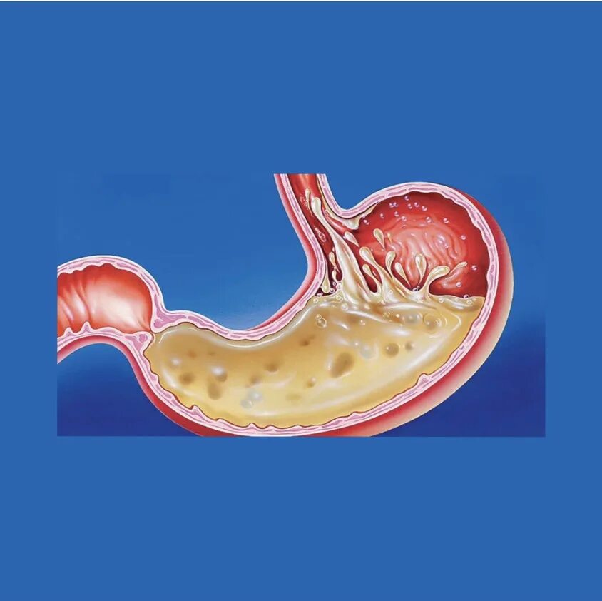 Кислотность желудка. Баллонирование желудка. Симптомы повышенной кислотности желудка у взрослых