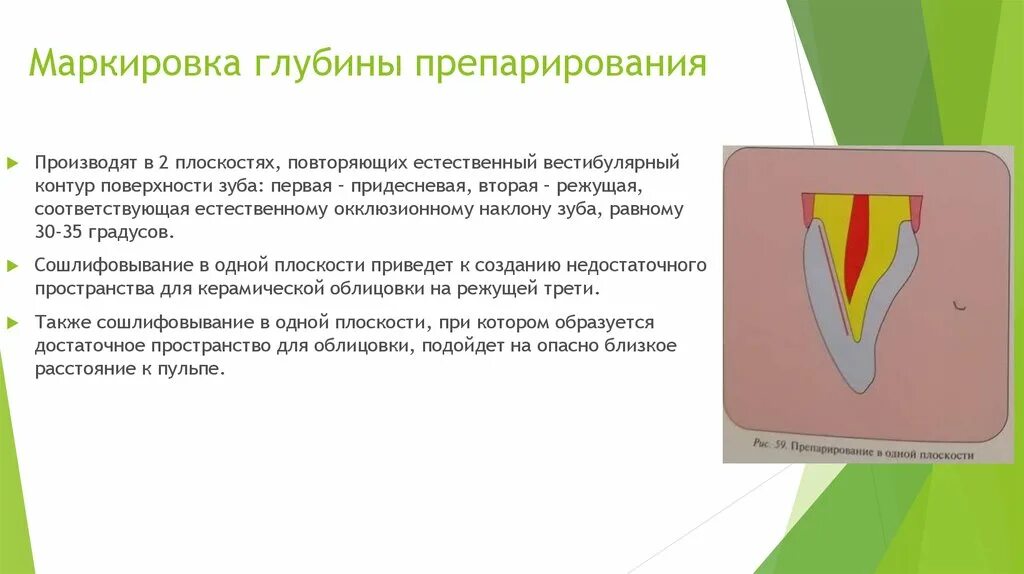 Принципы препарирования под вкладки. 9. методы контроля глубины препарирования.. маркировка глубины препарирования. препарирование под виниры схема. маркировка глубины препарирования под штампованную коронку.