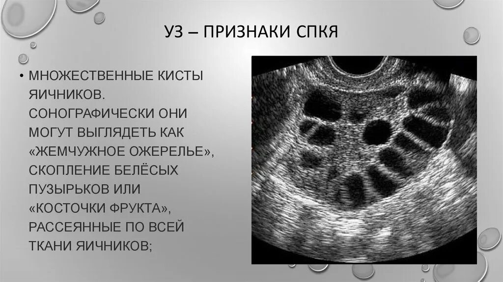 Синдром поликистозных яичников. Синдром поликистозных яичников симптомы. Мфя в гинекологии что