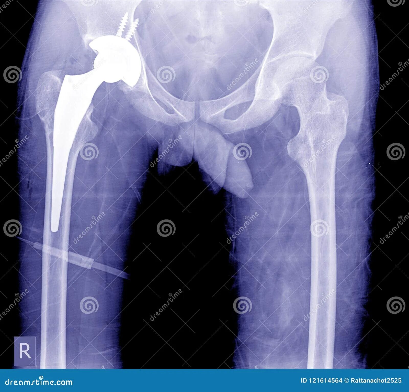 Шейка бедра в ноге. Перелом тазобедренного сустава рентген. Перелом шейки бедра рентген. Перелом шейки тазобедренного сустава рентген. Вывих эндопротеза тазобедренного сустава рентген.