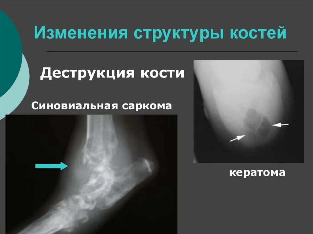 Изменения структуры костей рентген. Изменение костной структуры. Симптомы изменения структуры кости.