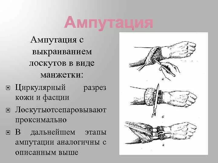 Уровни ампутации конечностей. Трехмоментная ампутация. Ампутация предплечья в нижней трети. Ампутация предплечья по способу манжетки. Ампутация предплечья в верхней трети.