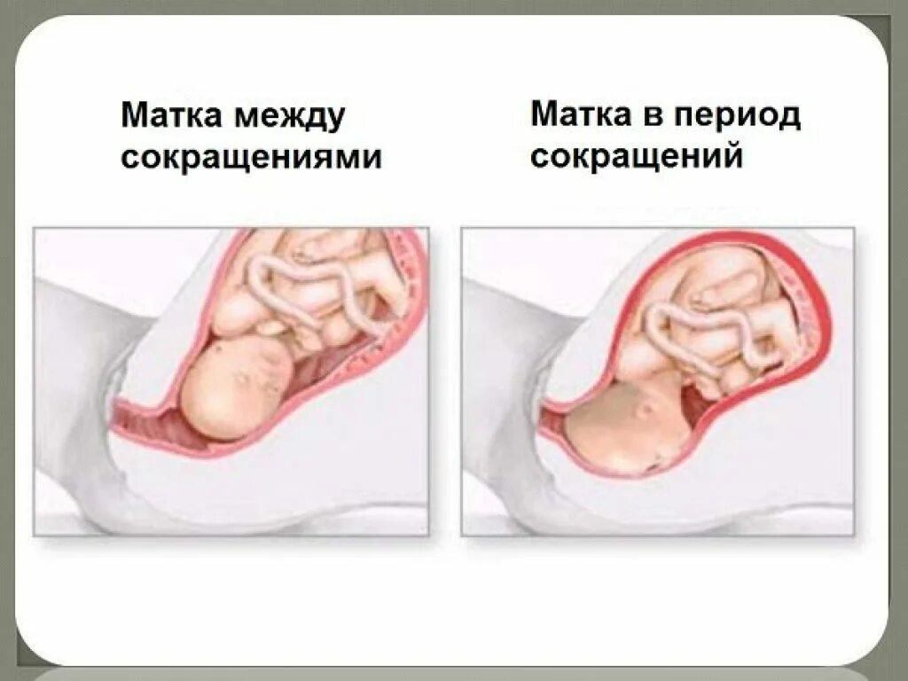 Гипертонус Матки Можно Заниматься Сексом