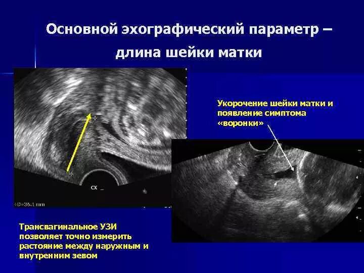 УЗИ беременность шейка норма. Открытый внутренний зев на УЗИ. Раскрытие внутреннего зева УЗИ. Ультразвуковое исследование шейки матки. Матка 25 мм
