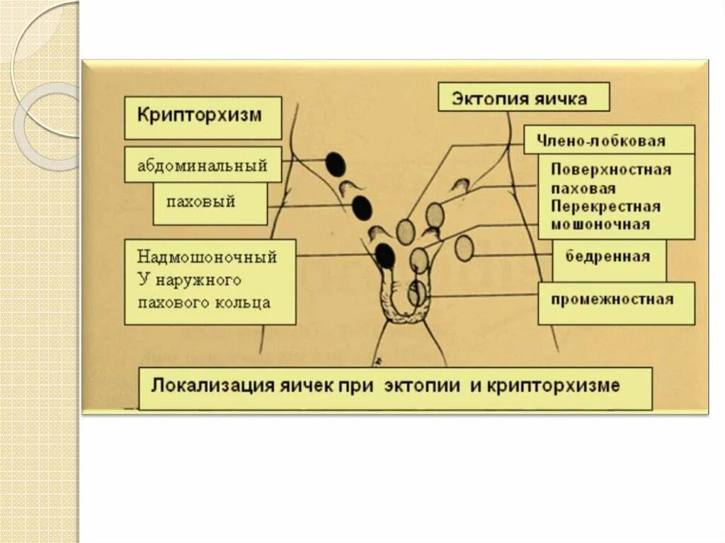 Крипторхизм лечение. Крипторхизм классификация. Локализация яичка при эктопии. Классификация крипторхизма у детей.