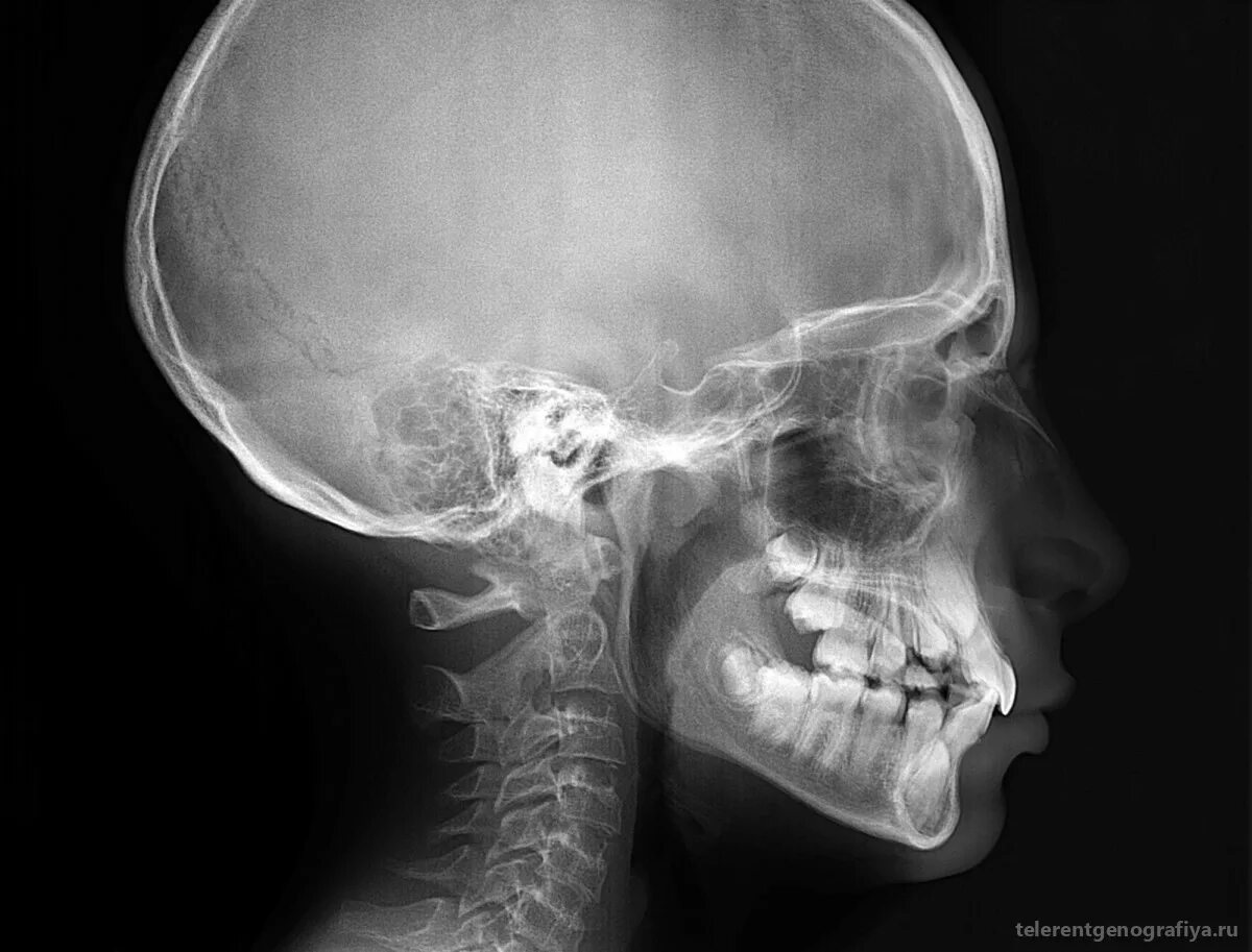 Детский череп рентген снимок. Снимок черепа новорождённого. Рентгенограмма черепа новорожденного.