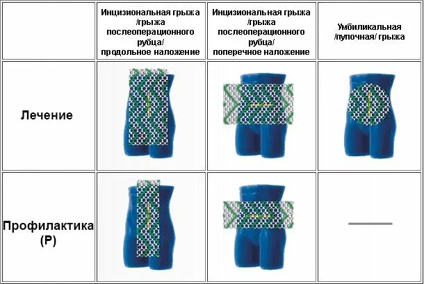 Какую сетку ставят при грыжах. Сетчатый имплант паховая грыжа. сетчатый имплант для пупочной грыжи. сетчатые импланты при грыжах. сетчатый эндопротез для грыжи.