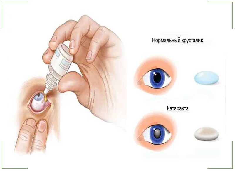 Капли после катаракты. Консервативная терапия катаракт. Лекарства для терапии катаракты;. Таблетки от катаракты глаза. Катаракт капли.
