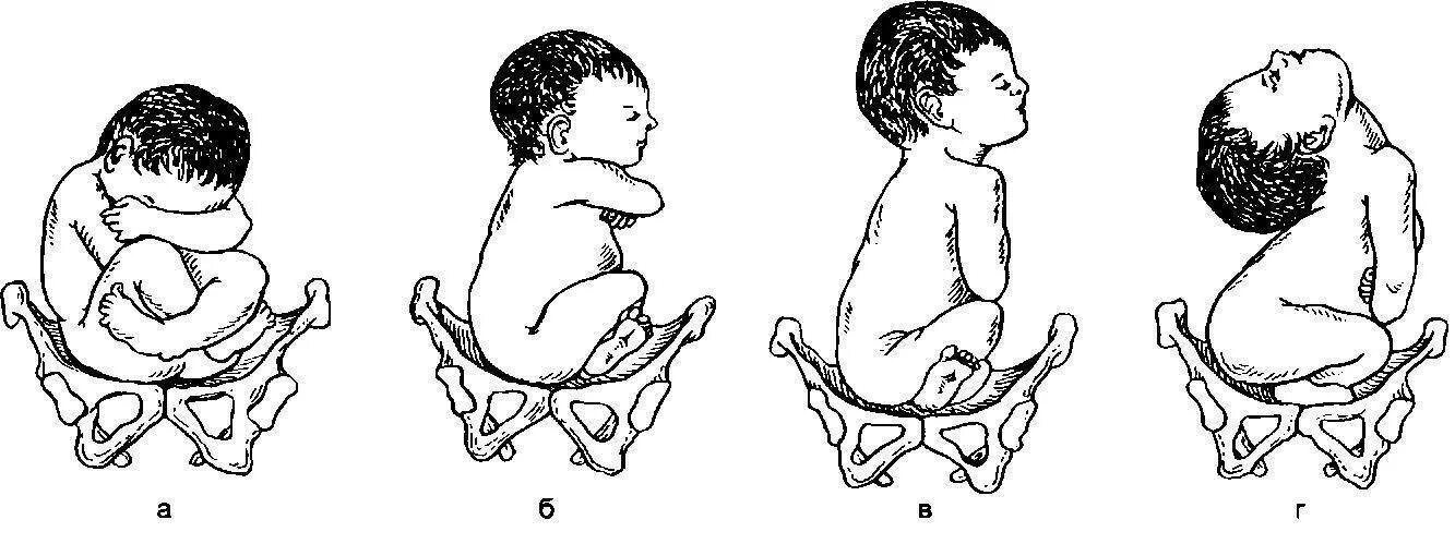 Положения головки плода. Ягодичное предлежание плода позиция 1. Тазовое ножное предлежание плода. Варианты положения головки плода при тазовом предлежании. Тазовое предлежание плода позиции.
