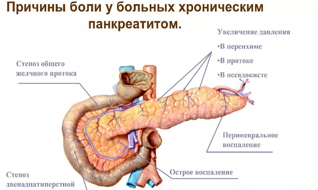 Где боли при поджелудочной железе. Хронический панкреатит поджелудочная железа. Болезнь хронический панкреатит поджелудочной железы. Симптомы панкреатита поджелудочной железы. Панкреатин поджелудочная железа.