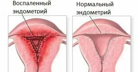 Эндометриоз и эндометрий разница