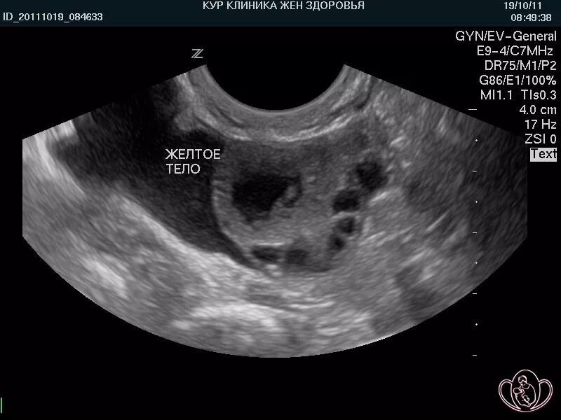 Желтое тело что это значит простыми словами. Регресс желтого тела на УЗИ. Яичник после овуляции на УЗИ. Жёлтое тело в яичнике на УЗИ.
