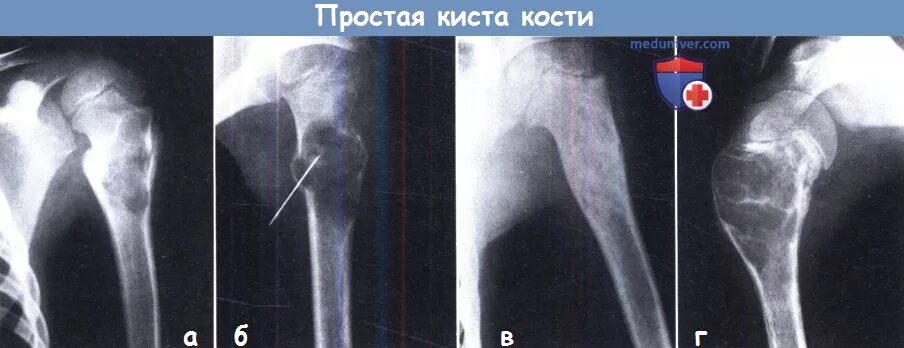 Как выглядит киста в жизни Киста на шейке матки Арт Минск.ру