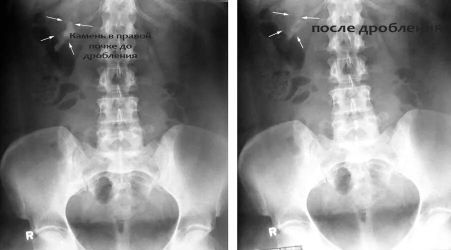 Как дробят камни в мочеточнике. Обзорная урограмма мочекаменная болезнь. Камни в почках (конкременты). Дробление почечных камней. Мочекаменная болезнь рентген.