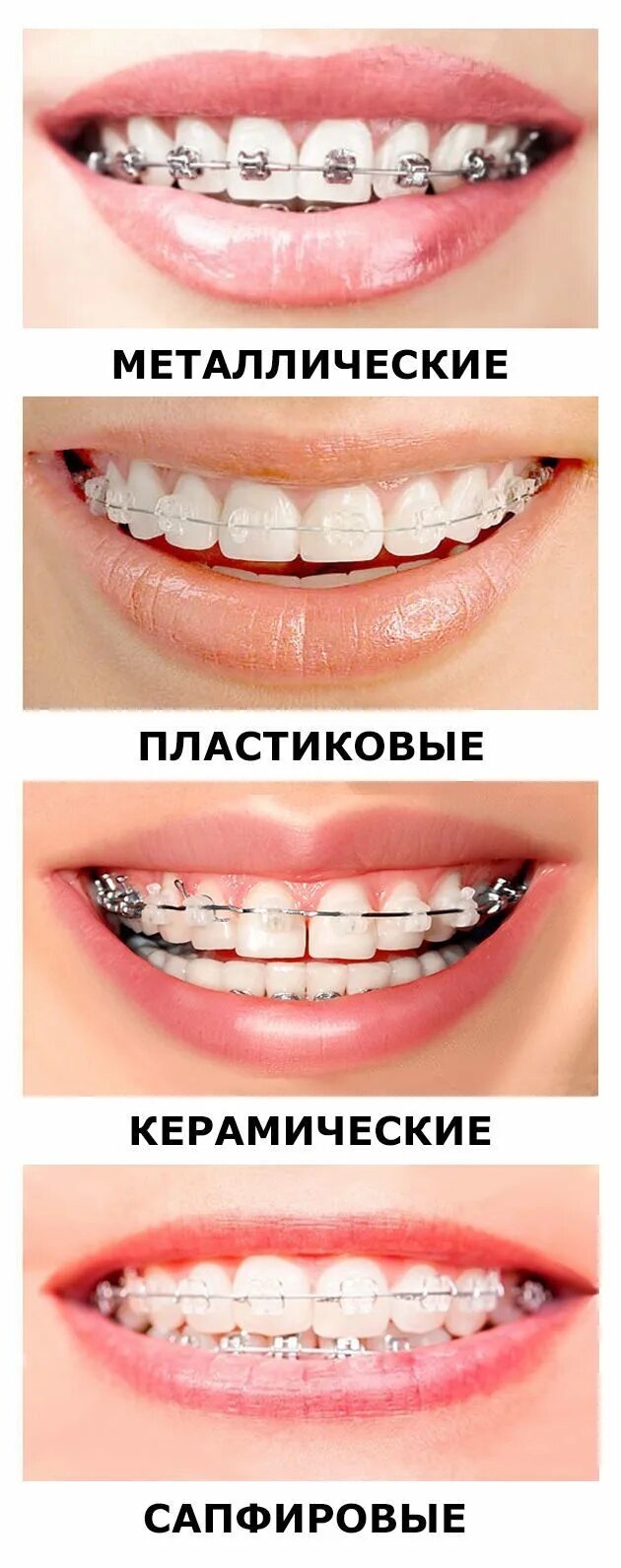 Ортодонт система. Сапфировые брекеты безлигатурные. сапфировые брекеты лигатурные. металлическая брекет-система на 1 зубной ряд. керамическая лигатурная брекет система.