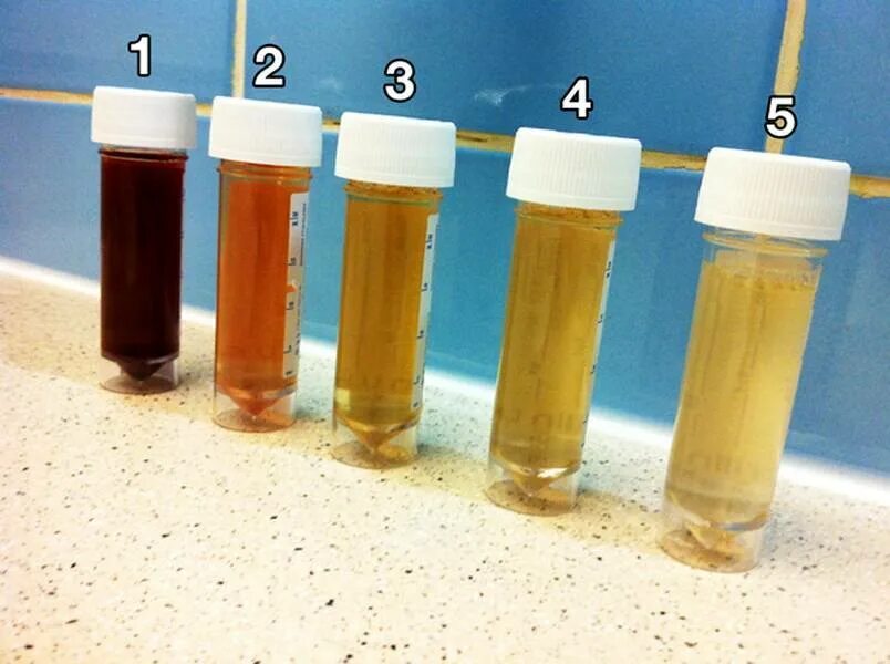 Золотистая моча. Темная моча. Нормальный цвет мочи. Цант мочи при гепатите.