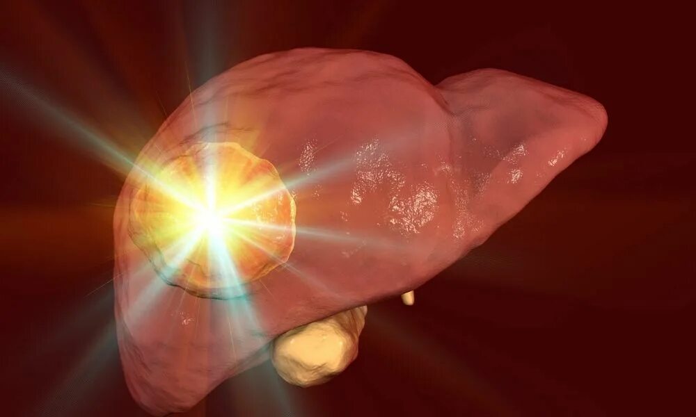 стадии опухоли. холангиофиброма печени. онкология народные средства. гепатокарцинома печени. опухоль печени симптомы.