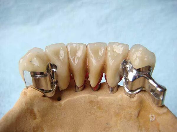 Комбинированные зубы. Цельнолитые металлокерамические мостовидные протезы. Несъёмные мостовидные шинирующие протезы. Металлокерамические мостовидные коронки. Керамические брекеты.