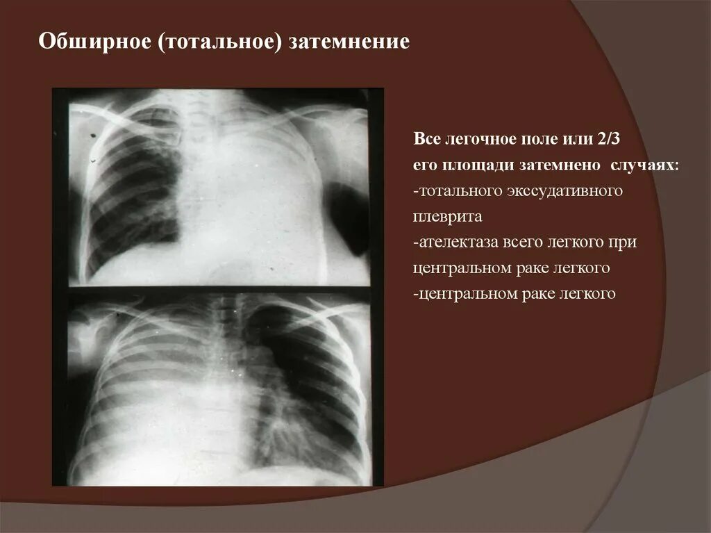 Рентген тотальное затемнение легкого. Синдром тотального затемнения легочного. Синдром тотального затемнения легочного поля. Синдром обширного затемнения легочного поля рентген. Затемнение в левом легком