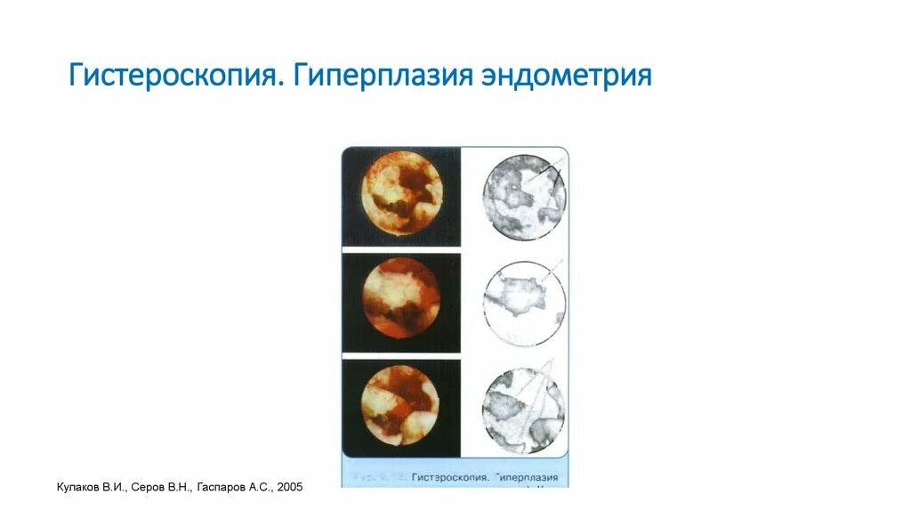 Гиперпластические процессы эндометрия гистероскопия. Гиперплазия эндометрия гистероскопическая картина. Гистероскопия при гиперплазии эндометрия. Железистая гиперплазия эндометрия предрак. Гиперплазия полости матки