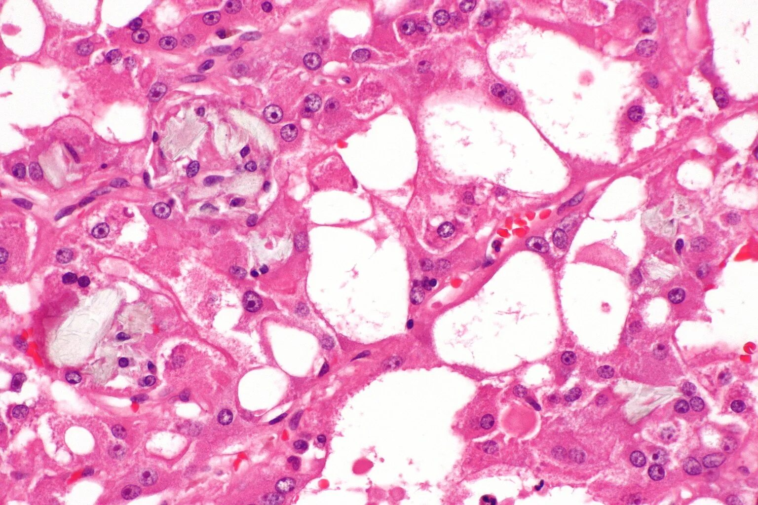 Франк renal Cell carcinoma. Cear Cell carcinoma vis multilocular Cysic renal. Diseases associated
