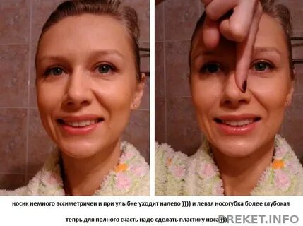 Щечный коридор при улыбке это