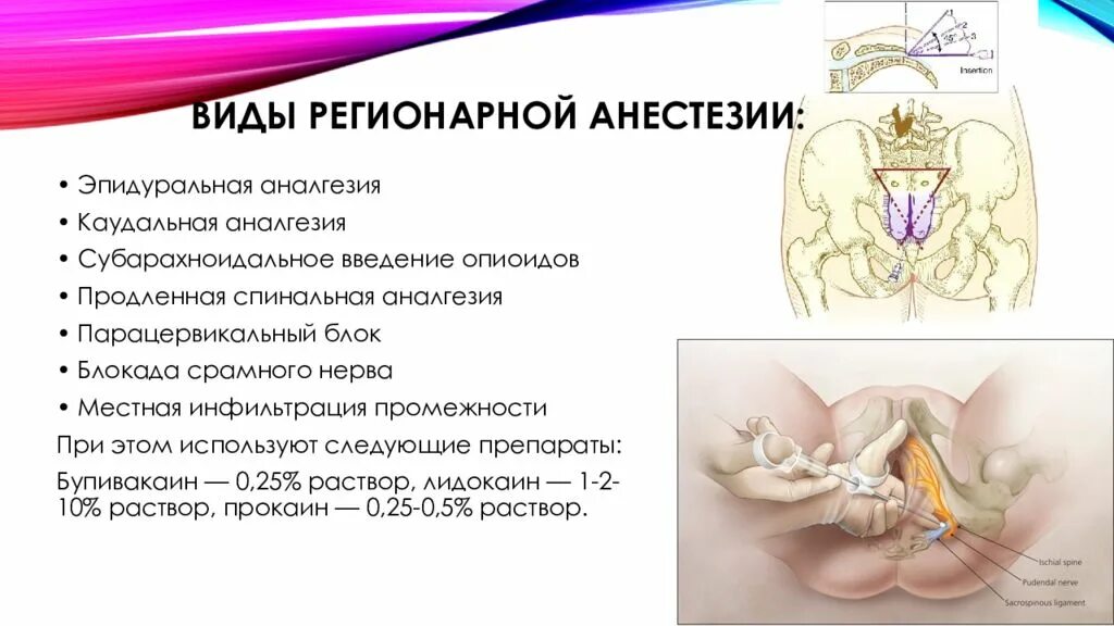 Блокады половые. Пудендальная анестезия. Промежностная блокада полового нерва. Пудендальная анестезия при родах.