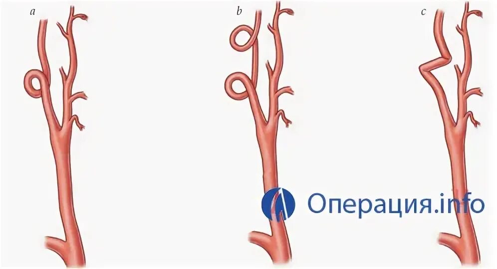 Изгиб вса. Кинкинг и койлинг. Койлинг ВСА. Кинкинг внутренней сонной артерии. Койлинг артерии.