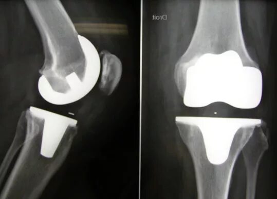 Трещина в протезе. Тотальное эндопротезирование коленного сустава цементная фиксация. Эндопротез коленного сустава рентген. Эндопротезирование коленного рентген. Тотальное эндопротезирование коленного сустава DEPUY.