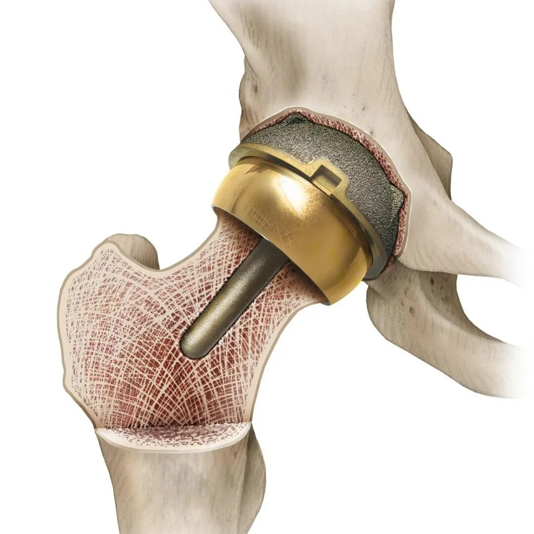 Можно ли делать протезирование суставов. Тотальное эндопротезирование коленного сустава. Интерпозиционная артропластика. Можно ли делать протезирование суставов. Эндопротезирование тазобедренного сус.