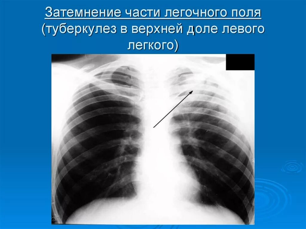 Затемнение в левом легком. Затемнение верхней доли легкого рентген. Затемнения лёгких на рентгене легких. Затемнение на рентгене легких. Затемнение в лёгких на рентгене.