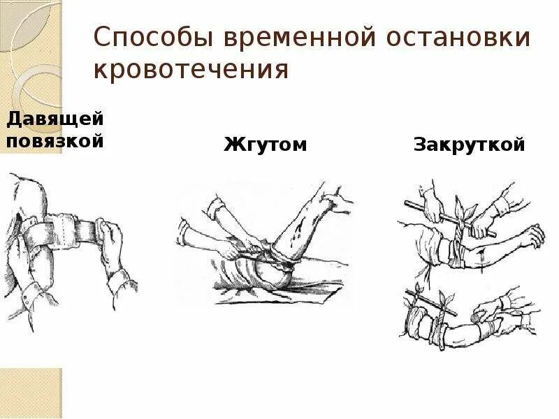 Пути остановки кровотечений. Метод временной остановки наружного венозного кровотечения:. Остановка наружного кровотечения алгоритм. Кровотечение методы остановки кровотечения. Способы остановки артериального и венозного кровотечения.