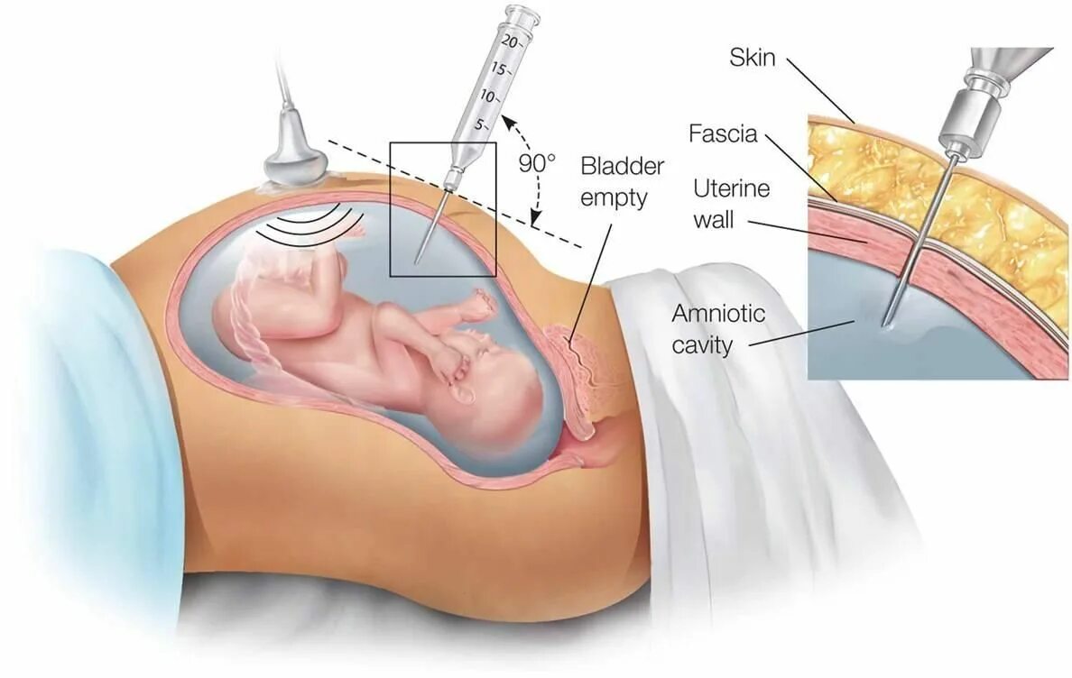 Ранние воды при беременности. Биопсия хориона амниоцентез кордоцентез. Исследование околоплодных вод амниоцентез. Пункция околоплодных вод. Пункция амниотической оболочки.