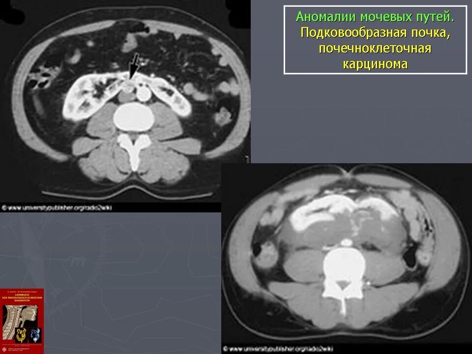 Аномалия мочевого. Объемные образования почек кт. Аномалия развития почек подковообразная. Ренинсекретирующая юкстагломелулярная опухоль почки.