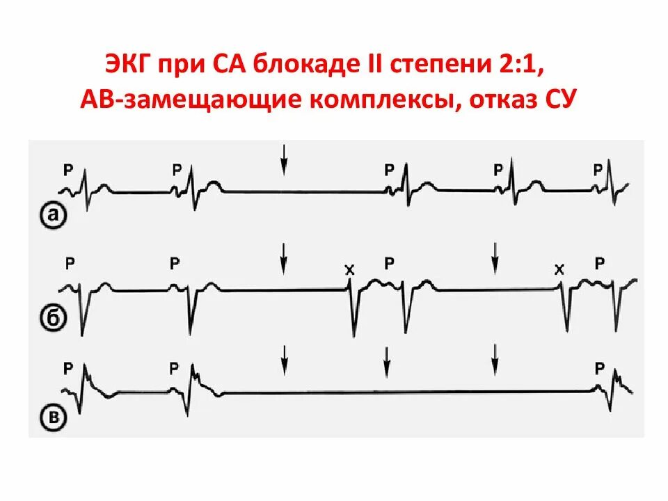 Са экг. Синоатриальная блокада мобитц 1 экг. синоатриальная блокада 1 степени на экг. синоатриальная блокада 2 степени на экг. при синоатриальной блокаде 1 степени на экг.