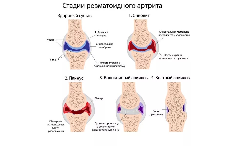 Ревматоидный артрит мышцы. Стадии ревматоидного артрита патанатомия. Суставно висцеральная форма ревматоидного артрита. Ревматоидный артрит патанатомия. Ревматоидный артрит 2 стадия.