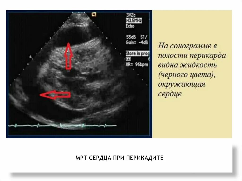 Скопление воздуха и крови в перикарде. Жидкость в перикарде на УЗИ норма. ЭХОКГ норма жидкости в перикарде. УЗИ признаки гидроперикарда. Констриктивный перикардит ЭХОКГ.