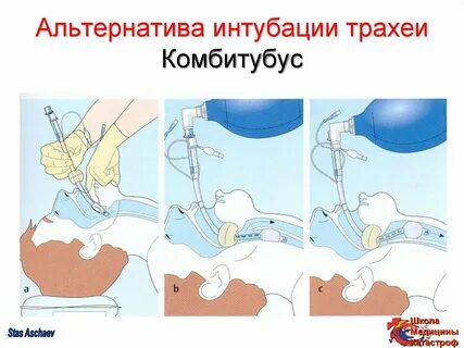 Интубация трахеи прием