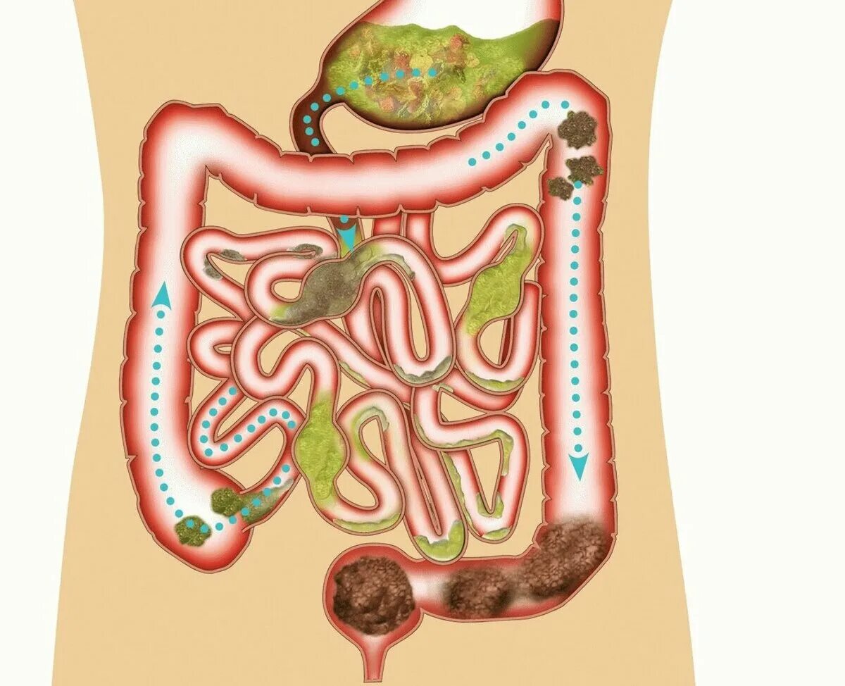 ленивый кишечник заставить работать у взрослого человека