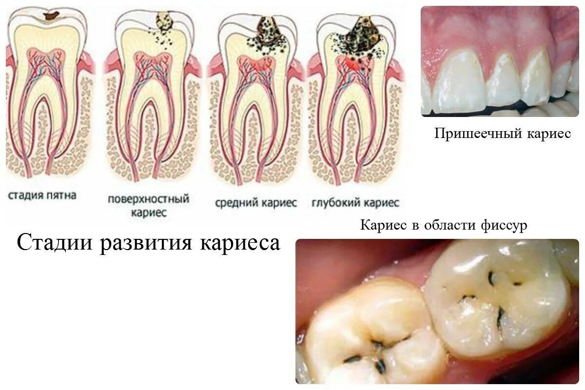 Признаки стороны зуба. Классификация кариес пульпит периодонтит. Этапы кариеса пульпита. Строение зуба кариес пульпит. Кариес дентина глубокий.