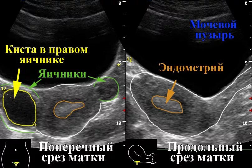 Узи где находится. Киста на яичнике узи у женщин. узи малого таза киста яичника. функциональные кисты яичников узи. киста яичника узи трансабдоминальное.
