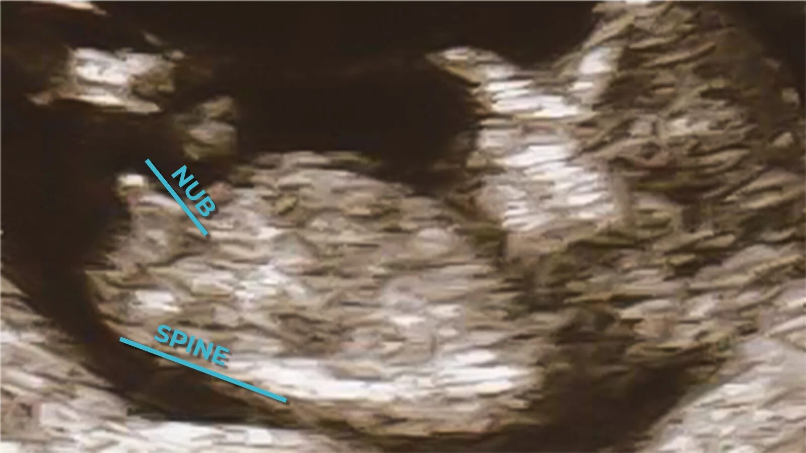 Скрининг при беременности 12-13 недель мальчик и девочка. Узи плода на 12 неделе беременности мальчик или девочка. Малыш на 13 неделе беременности узи мальчик. Девочка на 13 неделе. Узи 13 недель беременности мальчик.